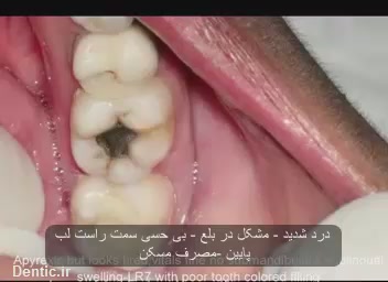 دندان با آبسه شدید