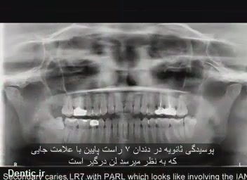 پوسیدگی ثانویه در دندان ۷ راست پایین