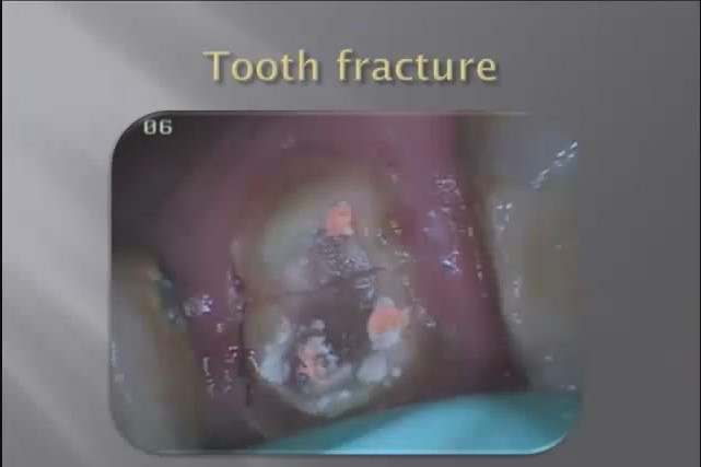 شکستتگی دندان tooth fracture