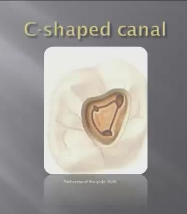 کانالهای C شکل C-shaped canal