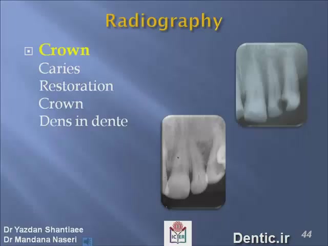 رادیوگرافی تاج دندان crown 