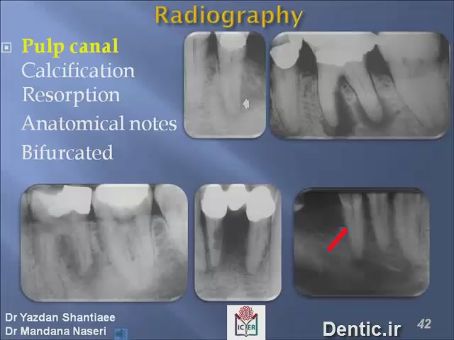 کانالهای دندان pulp canal