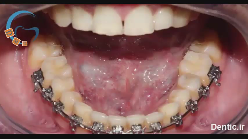 شکستگی یک ناحیه از ریتینر پایین شان ،یک نابجایی در دندان ثنایا