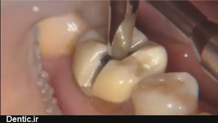 جدا کردن روکش دندان با سپریتور