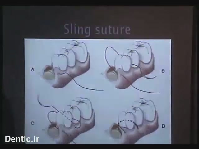 sling suture اسلینگ سوچور