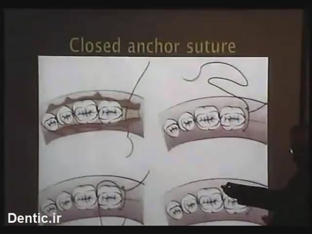 closed anchor suture کلوزد انکور سوچور
