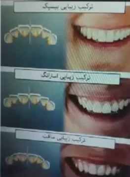 ویژگیهای و خصوصیات انواع ترکیبهای زیبایی دندان