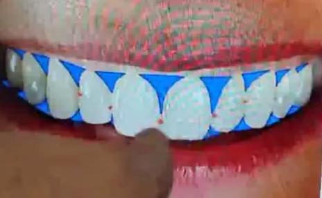 نقاط تماس و دندانهای قدامی و اختلاف آنها با امبراژورهای لثه ای