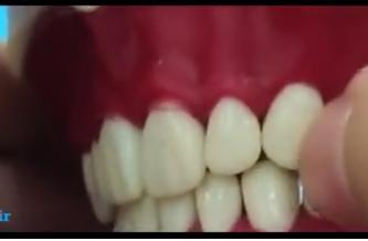  در دندان کانین لوب مرکزی برجسته تر است